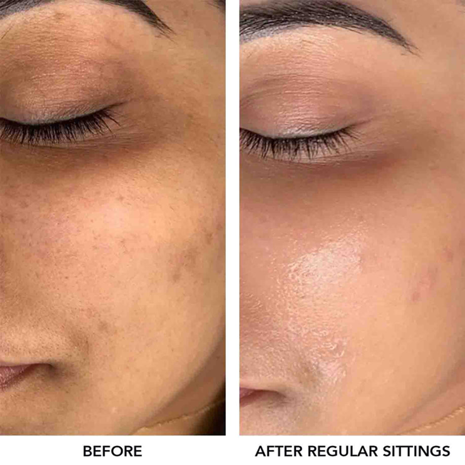 O3+ Meladerm Vitamin-C Gel Bleach