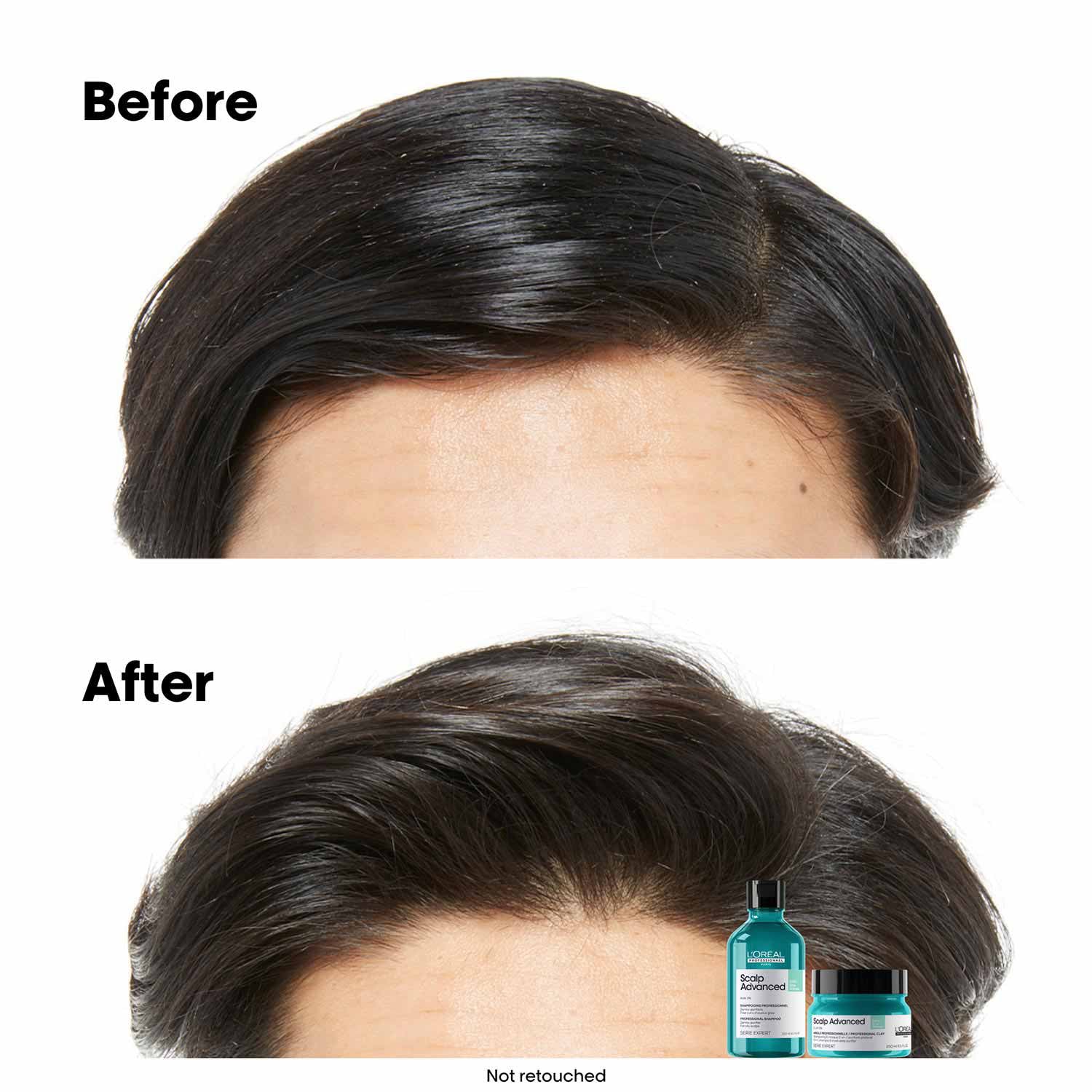 Loreal Scalp Advanced Anti-Grass Oiliness Professional Clay