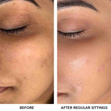 O3+ Meladerm Vitamin-C Gel Bleach