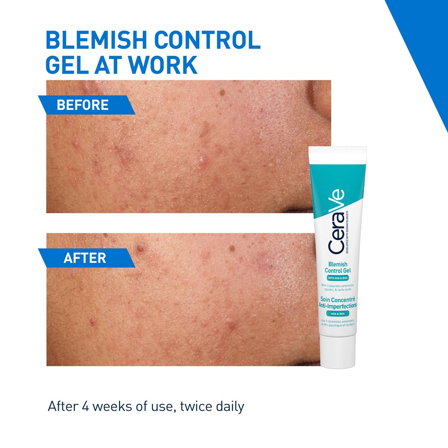 Cerave Blemish Control Gel With AHA & BHA
